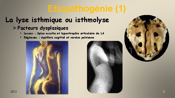 Etiopathogénie (1) La lyse isthmique ou isthmolyse Ø Facteurs dysplasiques § Locaux : Spina