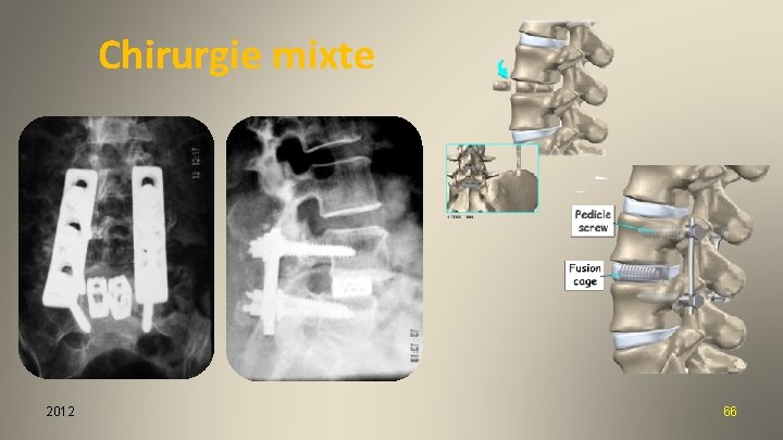 Chirurgie mixte 2012 66 