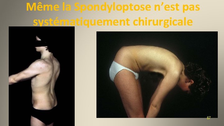 Même la Spondyloptose n’est pas systématiquement chirurgicale 2012 67 