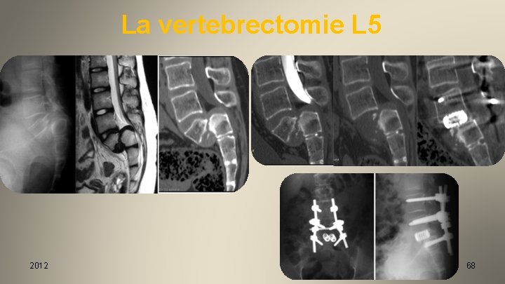 La vertebrectomie L 5 2012 68 