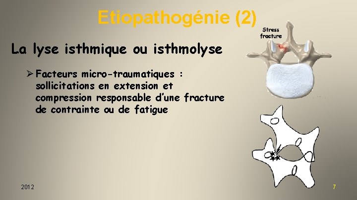 Etiopathogénie (2) La lyse isthmique ou isthmolyse Ø Facteurs micro-traumatiques : sollicitations en extension