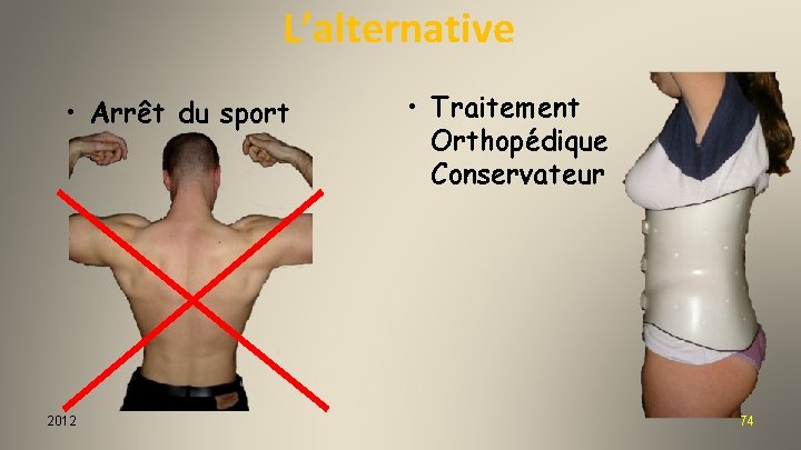 L’alternative • Arrêt du sport 2012 • Traitement Orthopédique Conservateur 74 