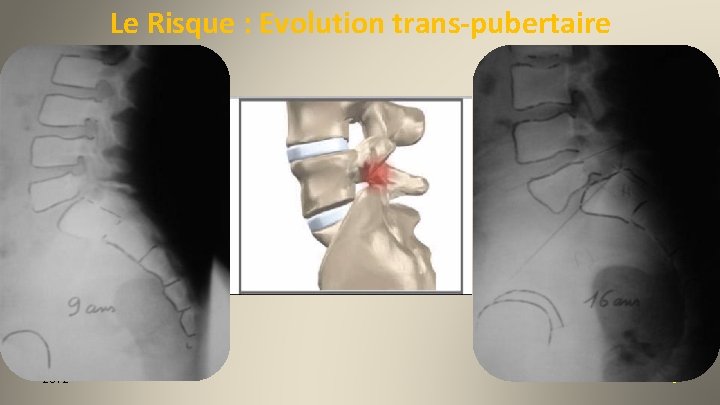 Le Risque : Evolution trans-pubertaire 9 ans 2012 16 ans 8 