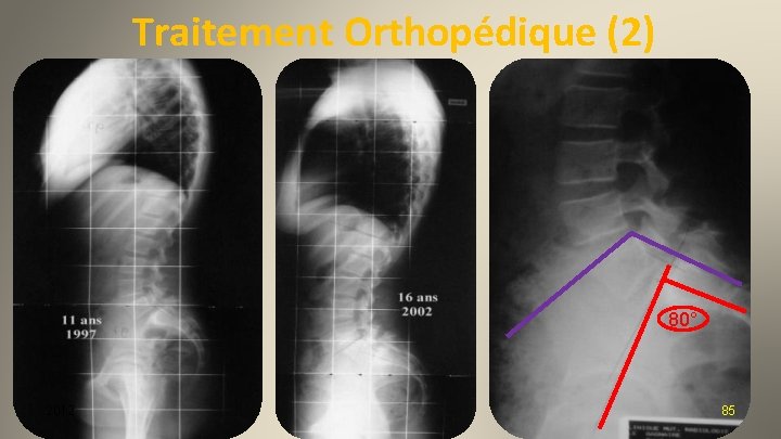 Traitement Orthopédique (2) 80° 2012 85 