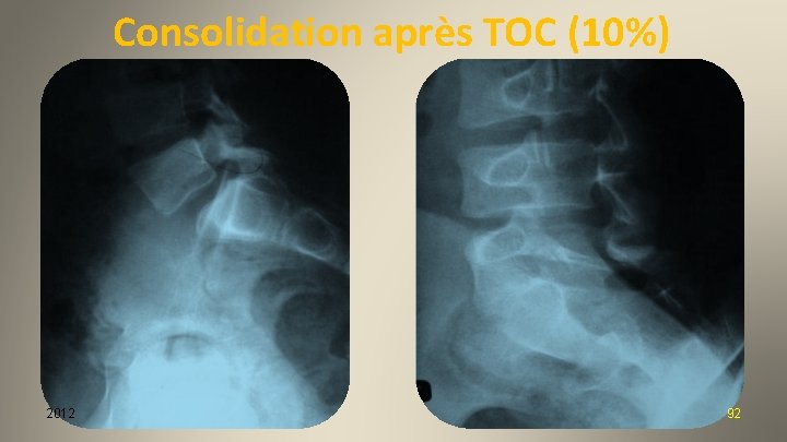 Consolidation après TOC (10%) 2012 92 