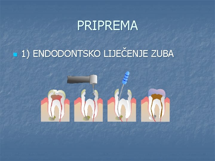 PRIPREMA n 1) ENDODONTSKO LIJEČENJE ZUBA 