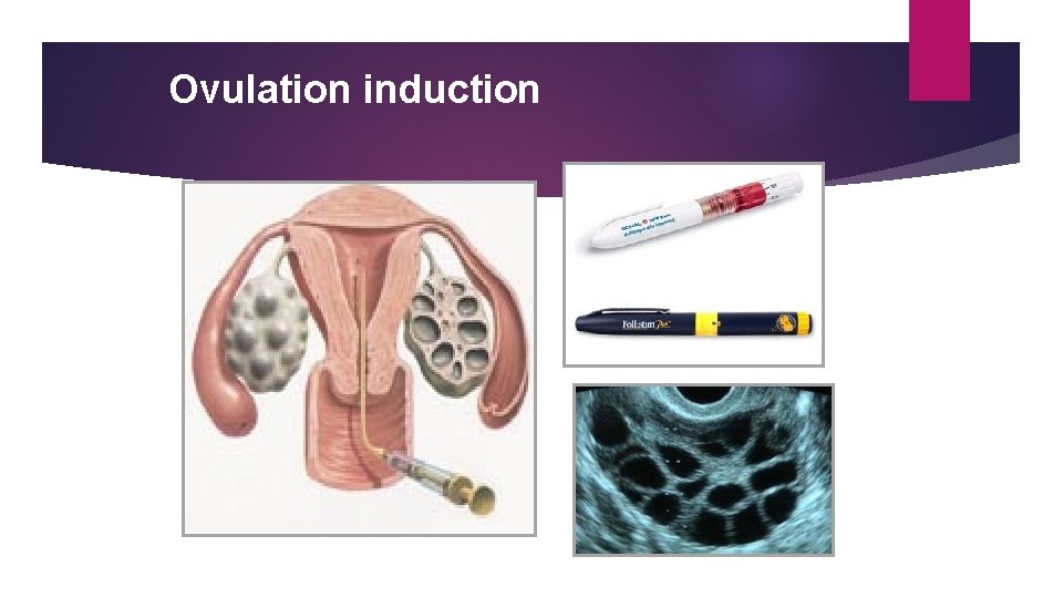 Ovulation induction 