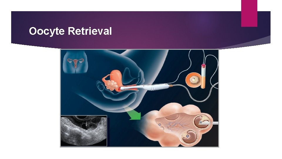 Oocyte Retrieval 