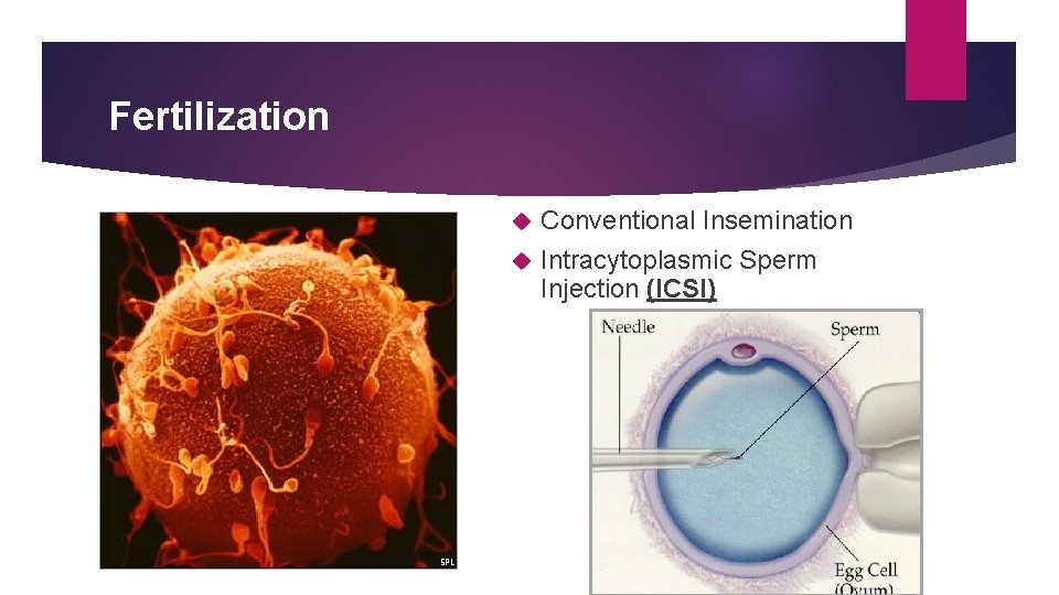 Fertilization Conventional Insemination Intracytoplasmic Sperm Injection (ICSI) 