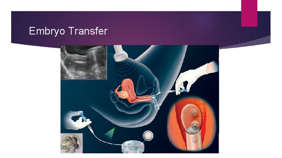 Embryo Transfer 