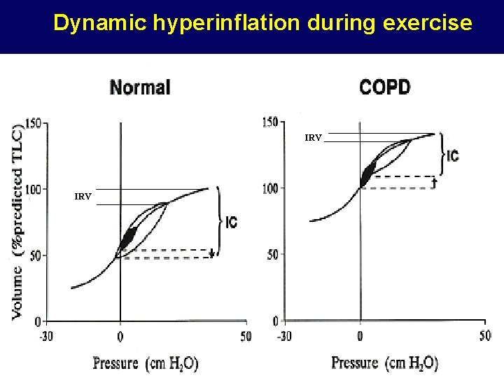 Dynamic hyperinflation during exercise IRV 