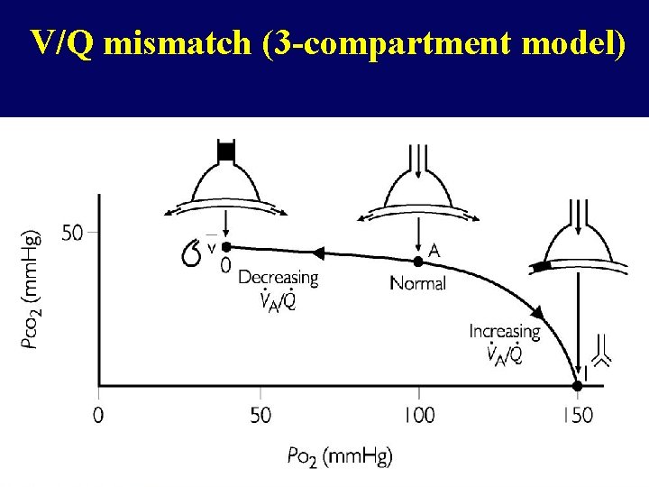 V/Q mismatch (3 -compartment model) 