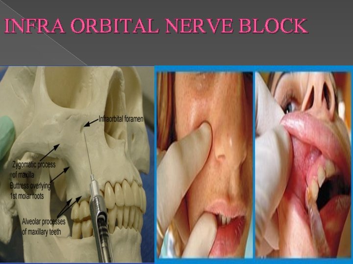 INFRA ORBITAL NERVE BLOCK 