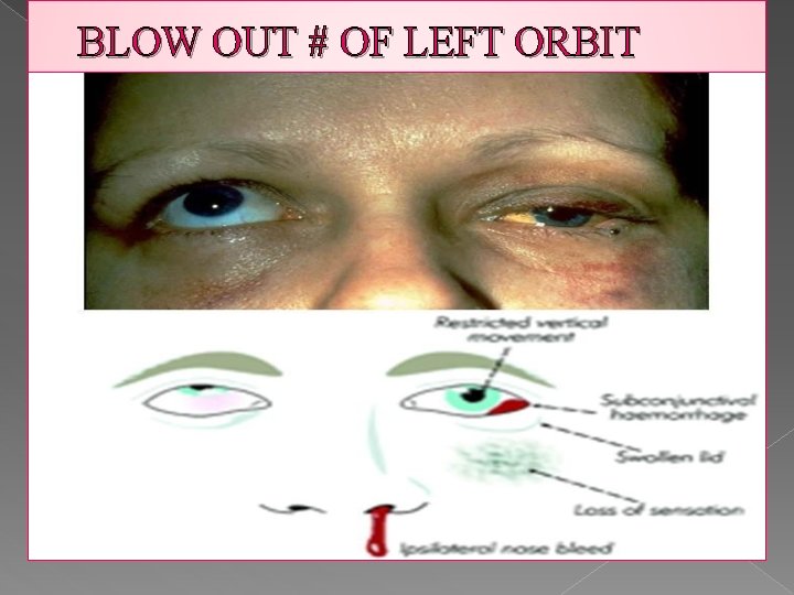 BLOW OUT # OF LEFT ORBIT 