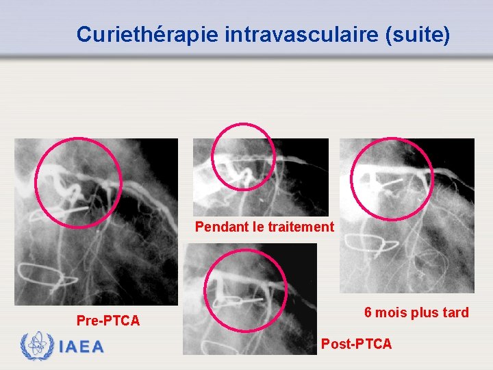 Curiethérapie intravasculaire (suite) Pendant le traitement Pre-PTCA IAEA 6 mois plus tard Post-PTCA 