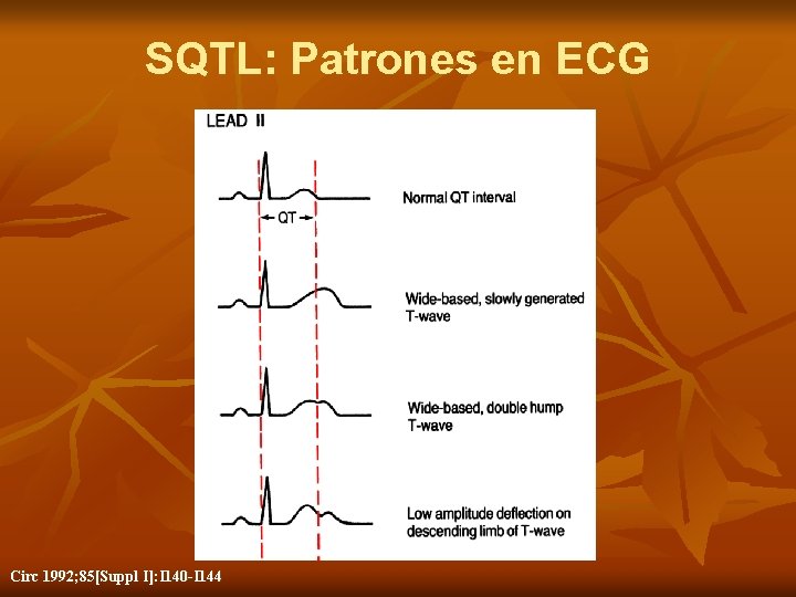 SQTL: Patrones en ECG Circ 1992; 85[Suppl I]: I 140 -I 144 