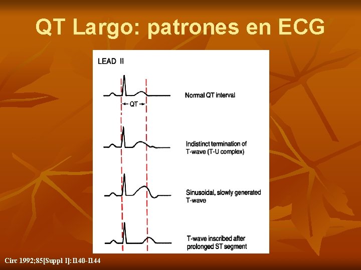 QT Largo: patrones en ECG Circ 1992; 85[Suppl I]: I 140 -I 144 