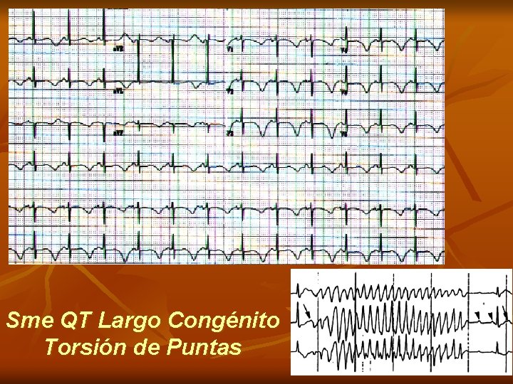 Sme QT Largo Congénito Torsión de Puntas 