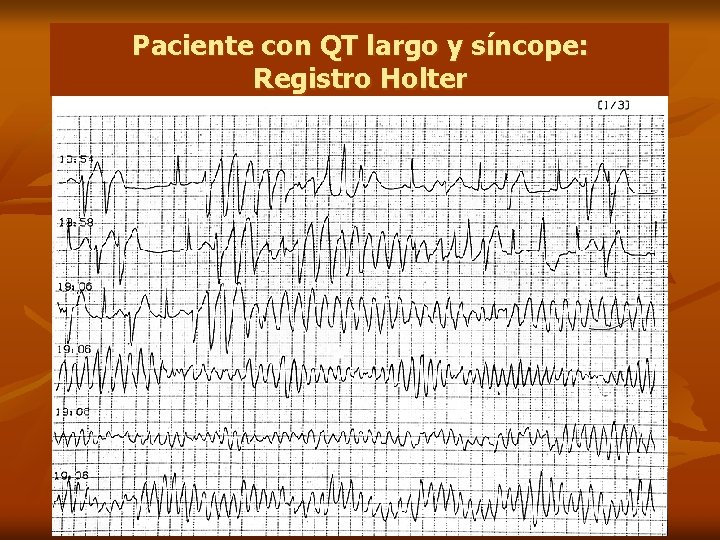 Paciente con QT largo y síncope: Registro Holter 
