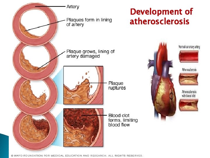 Development of atherosclerosis 