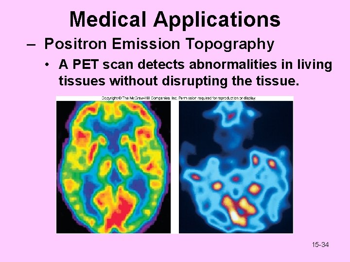 Medical Applications – Positron Emission Topography • A PET scan detects abnormalities in living