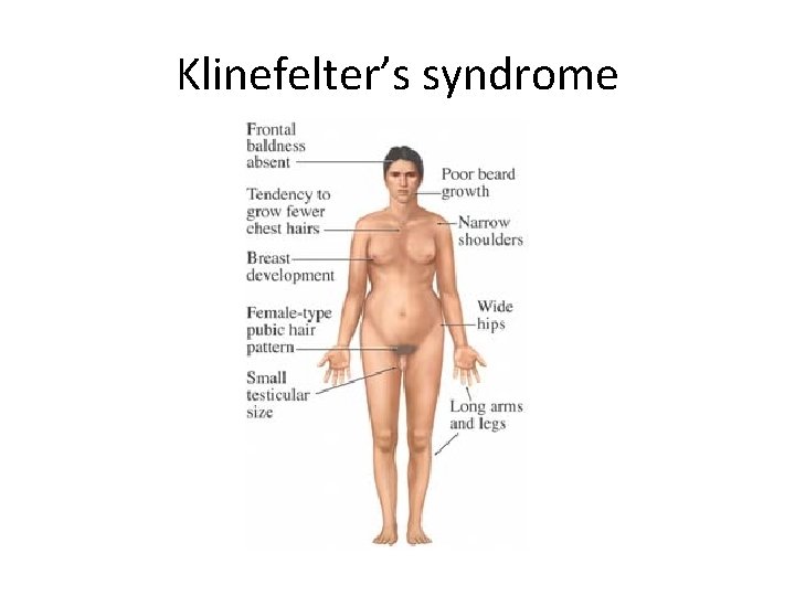 Klinefelter’s syndrome 