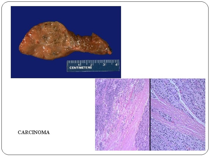 CARCINOMA 