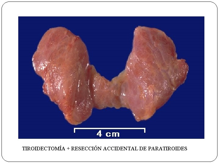 TIROIDECTOMÍA + RESECCIÓN ACCIDENTAL DE PARATIROIDES 