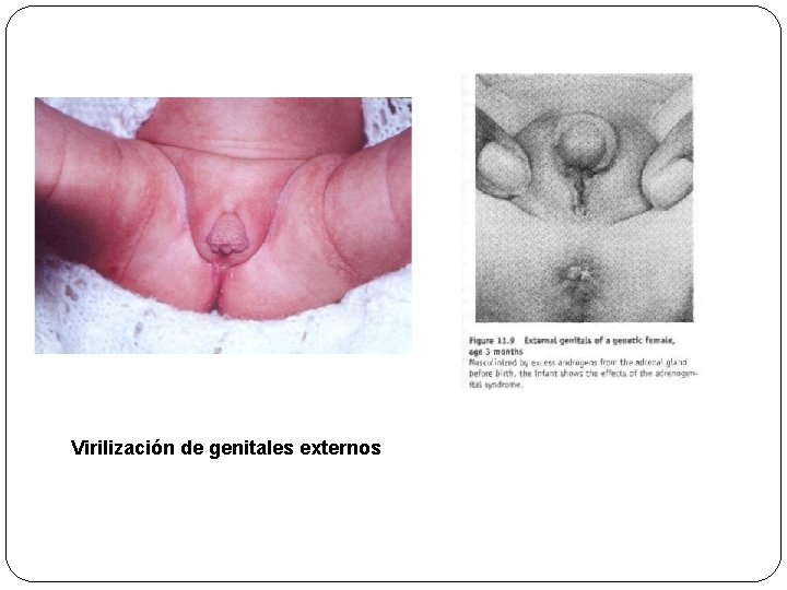 Virilización de genitales externos 