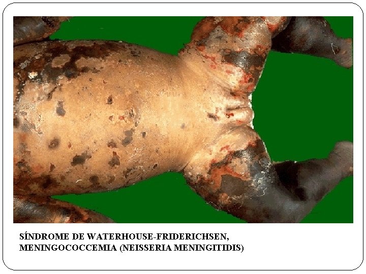 SÍNDROME DE WATERHOUSE-FRIDERICHSEN, MENINGOCOCCEMIA (NEISSERIA MENINGITIDIS) 