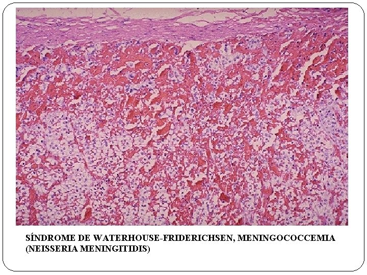 SÍNDROME DE WATERHOUSE-FRIDERICHSEN, MENINGOCOCCEMIA (NEISSERIA MENINGITIDIS) SÍNDROME DE WATERHOUSE-FRIDERICHSEN, MENINGOCOCCEMIA (NEISSERIA MENINGITIDIS)