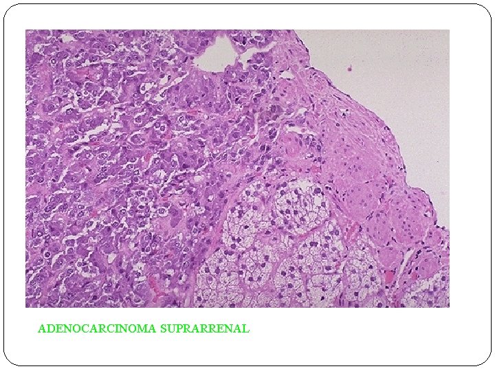 ADENOCARCINOMA SUPRARRENAL 