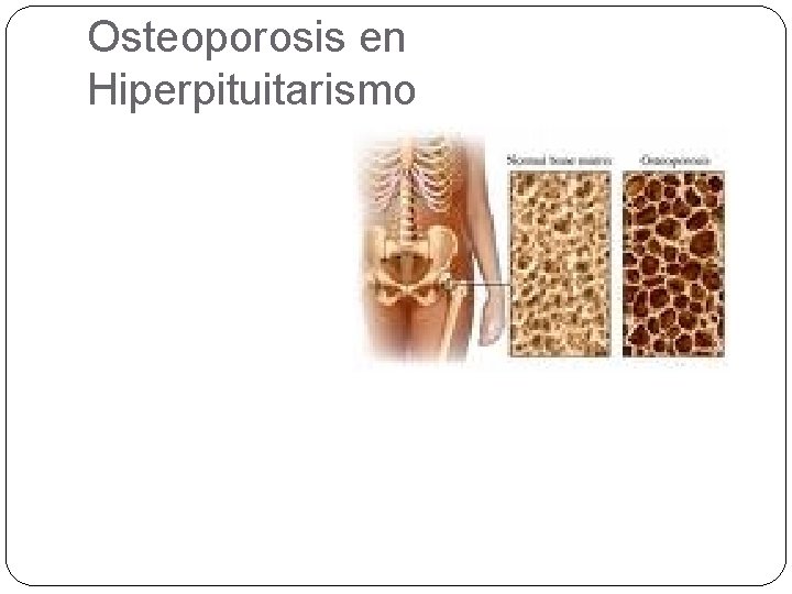 Osteoporosis en Hiperpituitarismo 