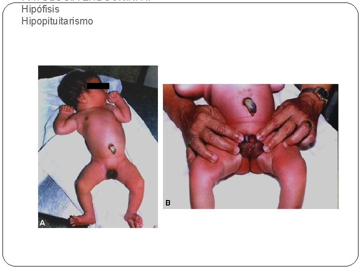 PATOLOGÍA ENDÓCRINA I. Hipófisis Hipopituitarismo 