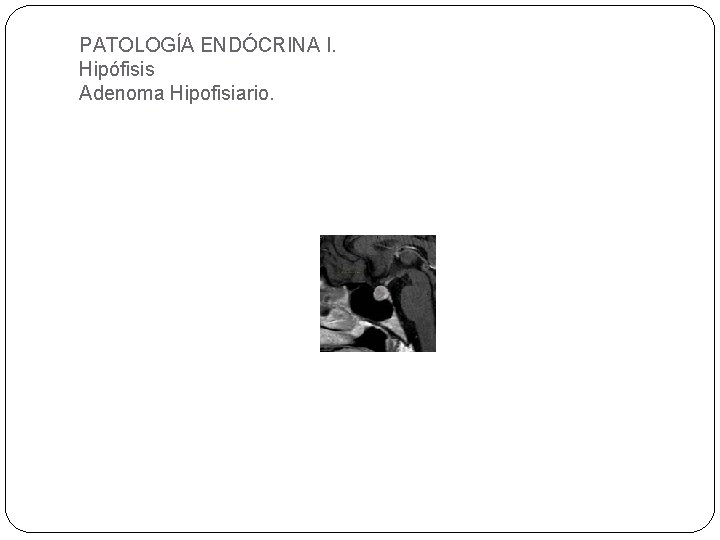 PATOLOGÍA ENDÓCRINA I. Hipófisis Adenoma Hipofisiario. 