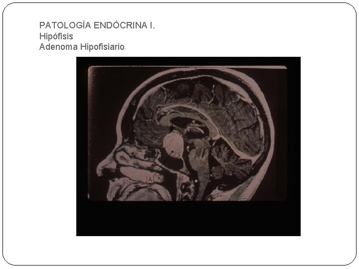 PATOLOGÍA ENDÓCRINA I. Hipófisis Adenoma Hipofisiario 