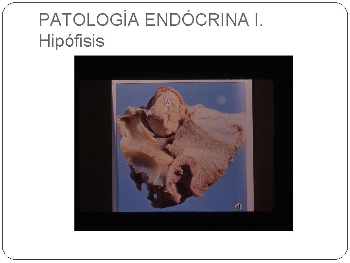 PATOLOGÍA ENDÓCRINA I. Hipófisis 