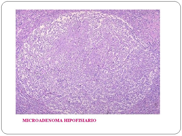 MICROADENOMA HIPOFISIARIO 