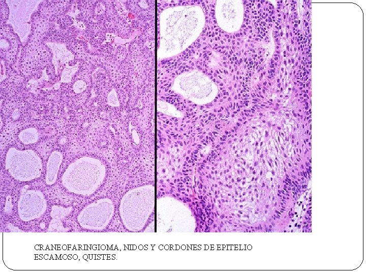 CRANEOFARINGIOMA, NIDOS Y CORDONES DE EPITELIO ESCAMOSO, QUISTES. CRANEOFARINGIOMA, NIDOS Y CORDONES DE EPITELIO ESCAMOSO, QUISTES.