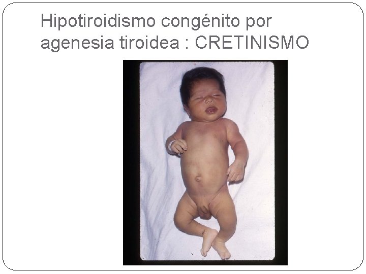 Hipotiroidismo congénito por agenesia tiroidea : CRETINISMO 