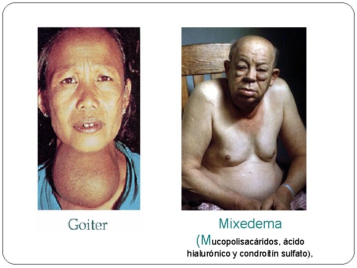 Mixedema (Mucopolisacáridos, ácido hialurónico y condroitín sulfato), 