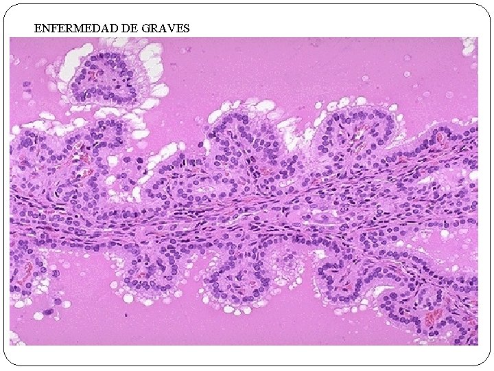 ENFERMEDAD DE GRAVES 