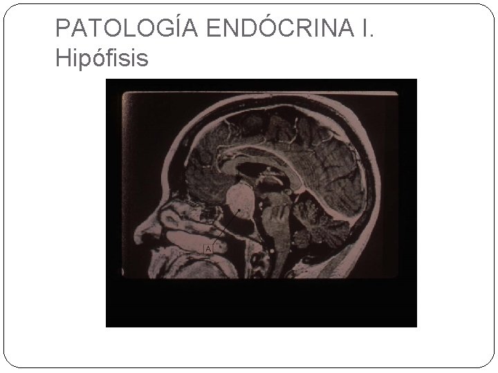 PATOLOGÍA ENDÓCRINA I. Hipófisis 