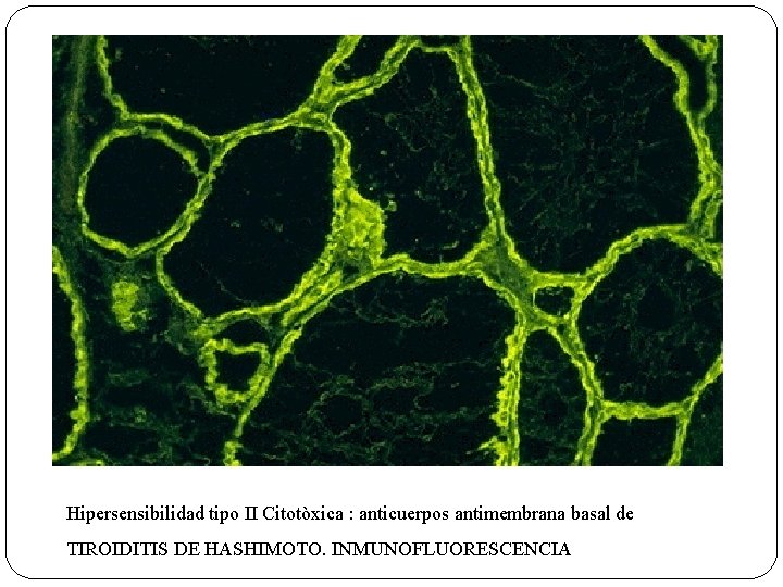 Hipersensibilidad tipo II Citotòxica : anticuerpos antimembrana basal de TIROIDITIS DE HASHIMOTO. INMUNOFLUORESCENCIA 