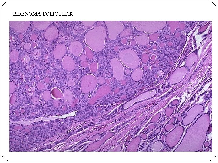 ADENOMA FOLICULAR 