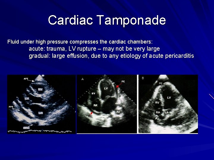 Cardiac Tamponade Fluid under high pressure compresses the cardiac chambers: acute: trauma, LV rupture
