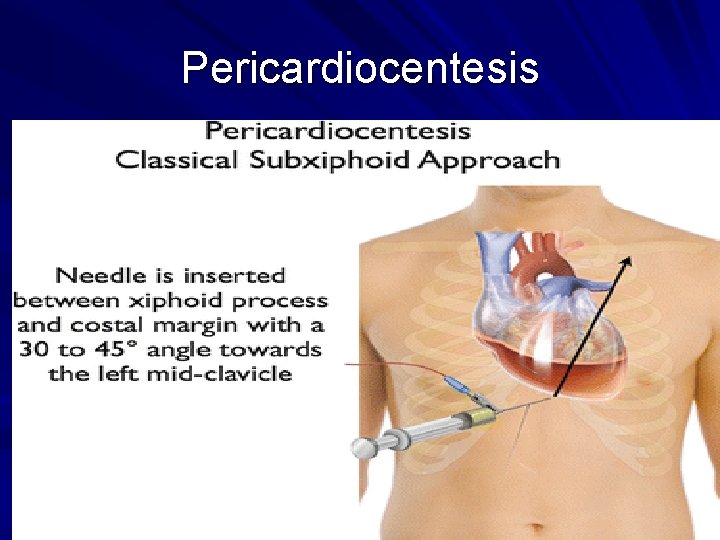 Pericardiocentesis 