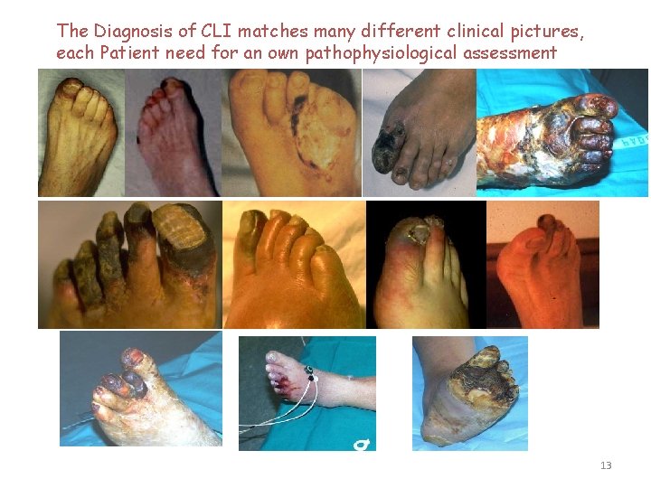 The Diagnosis of CLI matches many different clinical pictures, each Patient need for an