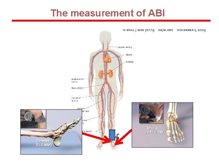 The measurement of ABI 