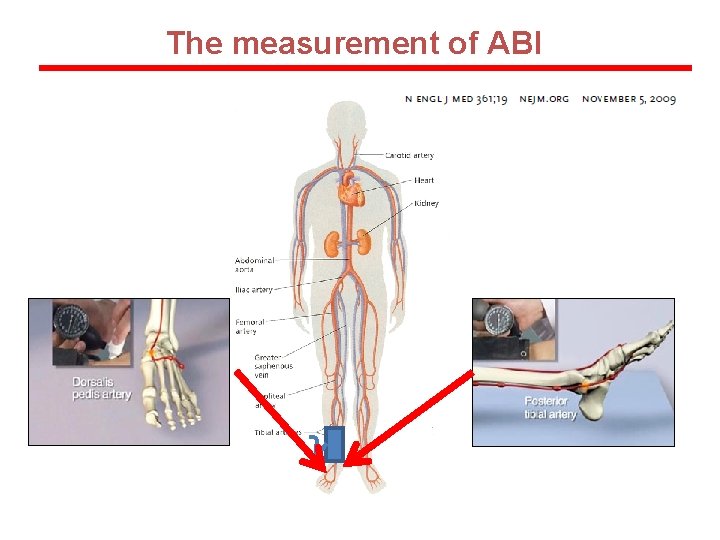 The measurement of ABI 